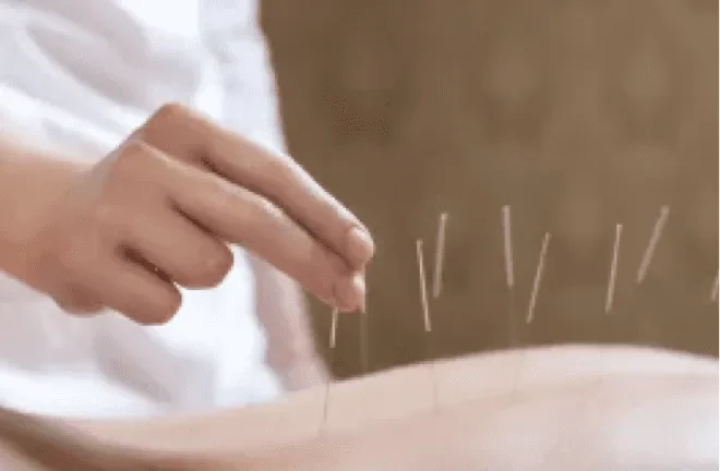 Иглотерапия Иглотерапия